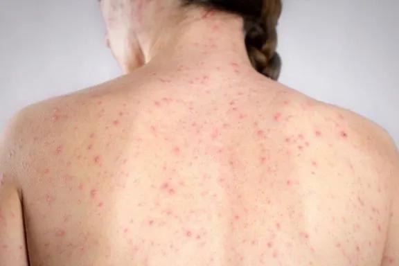 Chile declaró alerta por sarampión ante el aumento de casos en Argentina