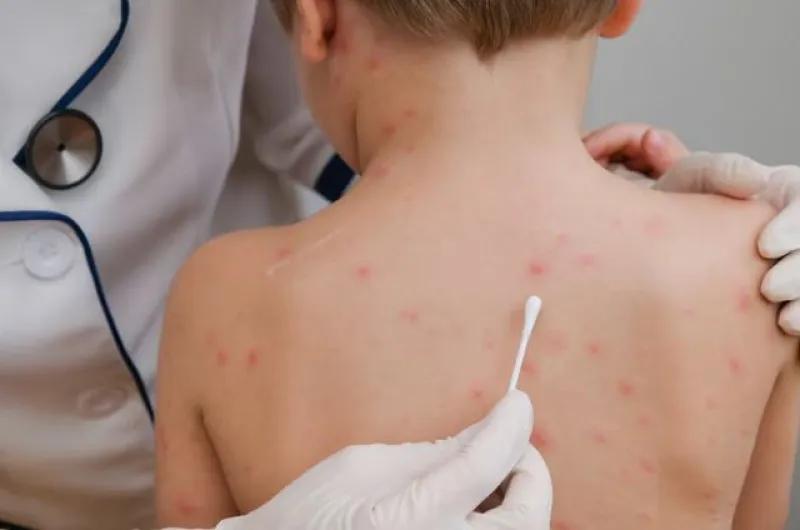 Preocupación sanitaria: Argentina monitorea cerca de 100 contactos estrechos por sarampión