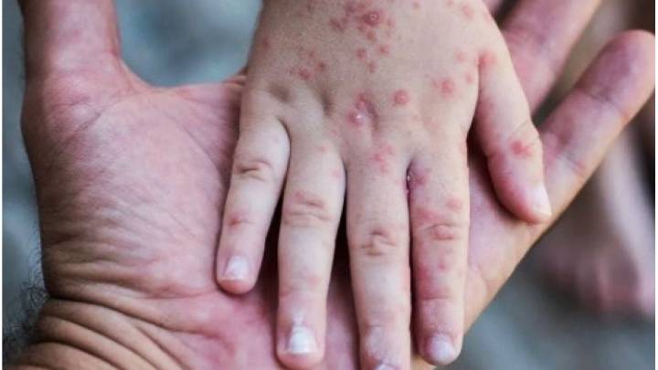 Confirman el primer caso de sarampión en Entre Ríos