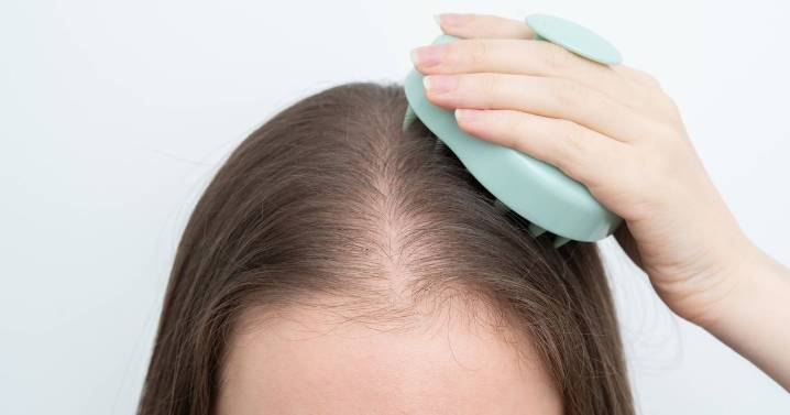 One in three women avoid social gatherings due to hair loss, new research shows