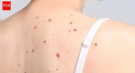 What those tiny red moles on your skin actually mean: Causes, risks and treatment options for cherry angiomas