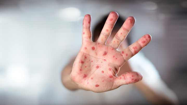 What to know about Arizona’s measles outbreak