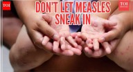 Measles outbreak in South Carolina could hit India next: Tips to stay protected