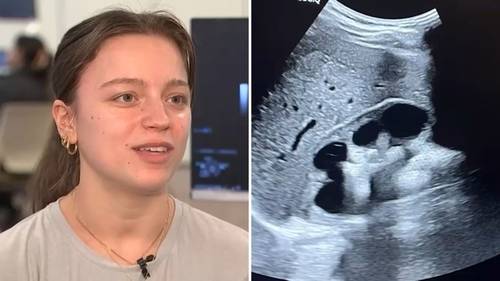 Medical lesson turns into life-saving discovery of mass found on student's kidney at Hofstra University