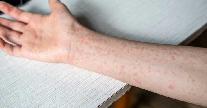 Can You Get Measles If You're Vaccinated?