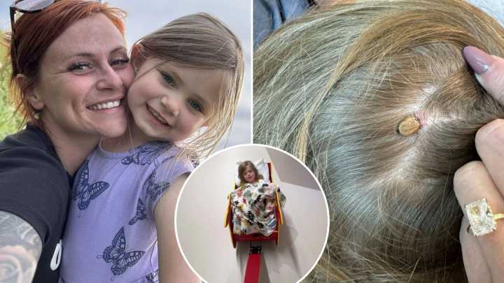 'Perfectly healthy' girl, 4, left paralysed after family camping trip due to giant critter feasting on her scalp