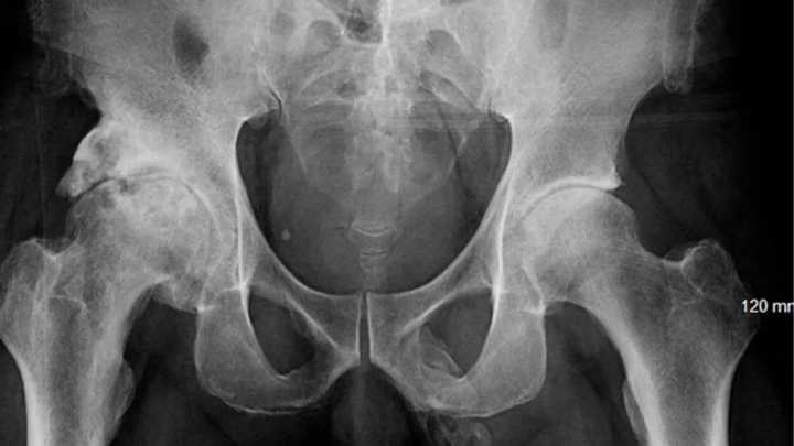 Man discovers his penis is 'turning to BONE' after trip to A&E following a fall
