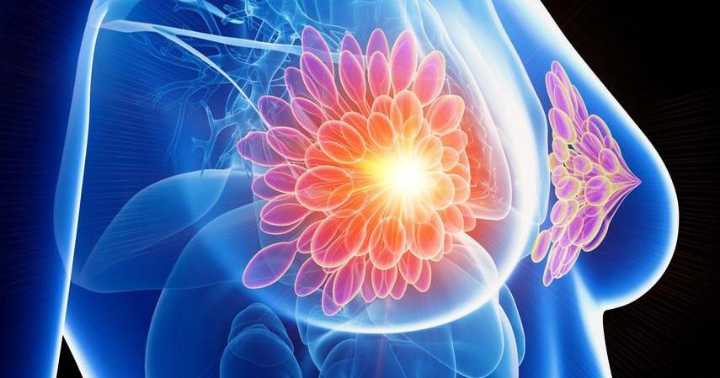 Científicos usan inteligencia artificial para predecir evolución del cáncer en mujeres