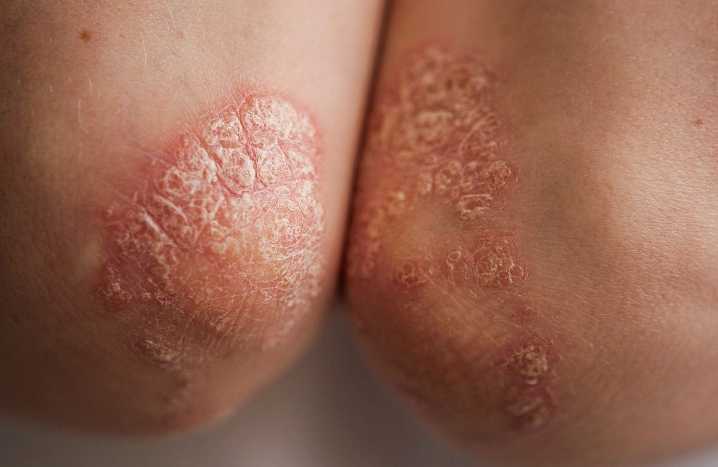 Central Adiposity Measures Associated With Psoriasis Risk