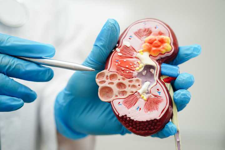 FDA Grants Priority Review to Sibeprenlimab for the Kidney Disease IgAN