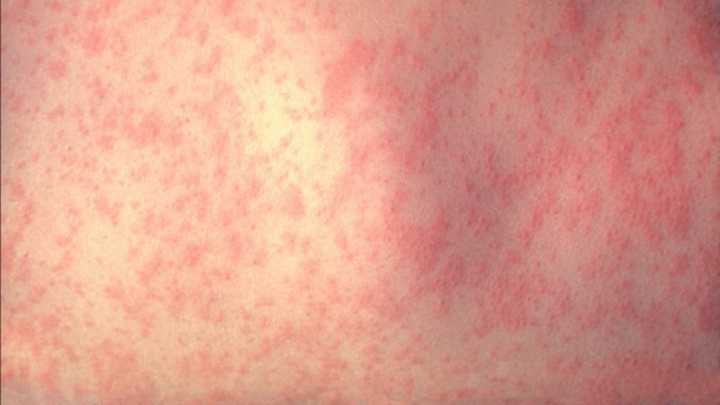 Texas measles outbreak: State sees increase in cases not connected to outbreak