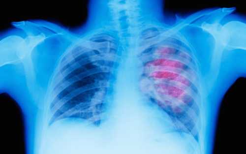 New Biomarker Can Predict Survival Outcomes in NSCLC Patients
