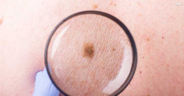 Stay ‘sun sensible’ and lower your skin cancer risk as temps rise