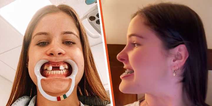 This Girl Spent 6 Years Fixing Her Jaw & After the Final Surgery, She Stunned Everyone with the Results