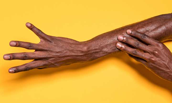 Dry, Cracked Hands? It Could Be Eczema — Here's What Experts Say To Do