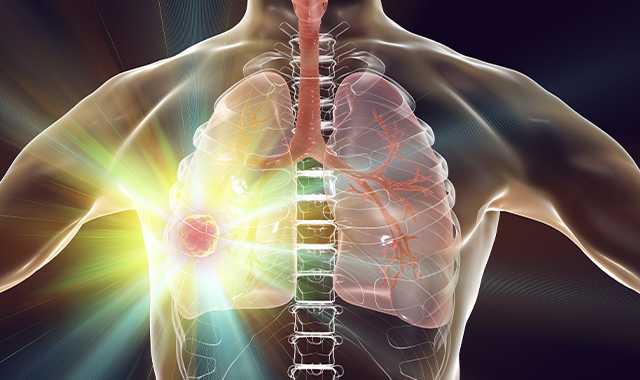 Combining Avastin With Alecensa Shows Promise in Advanced ALK