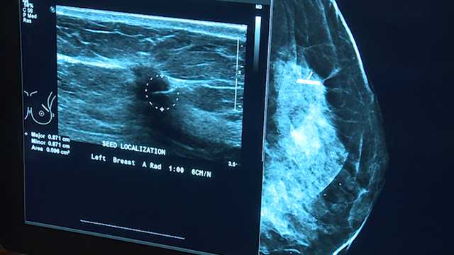 Study: Fewer radiation treatments effective for breast cancer