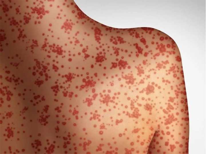 Measles exposure reported at school and museum, public health issues advisory