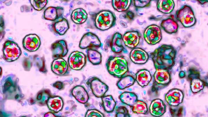 Fifth measles case confirmed in Georgia