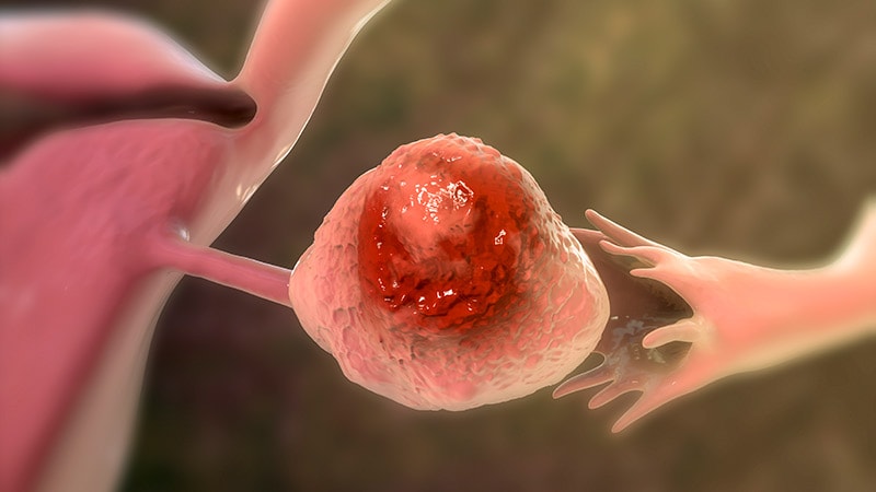 Relacorilant + Nab-Paclitaxel Beneficial in Ovarian Cancer
