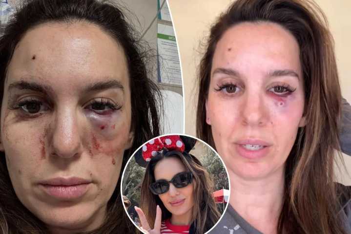 Former Disney Channel star Christy Carlson Romano gives update after being shot in eye