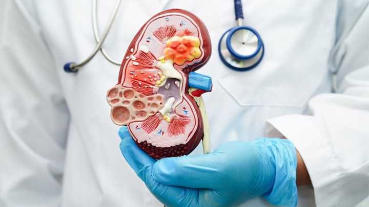 Pegcetacoplan Maintains Kidney Benefits at 52 Weeks