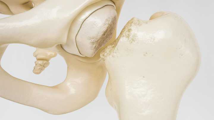 Setting Up a Successful Fracture Liaison Service