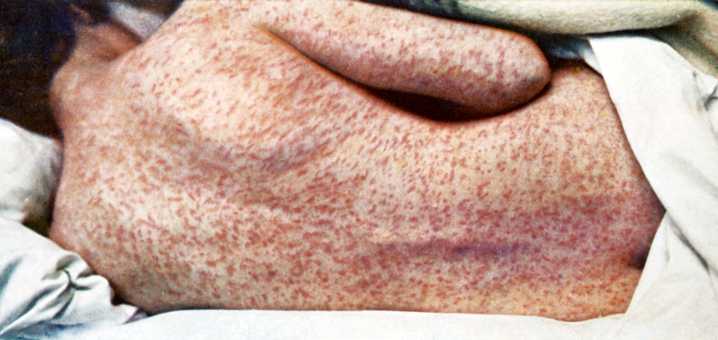 Fifth Measles Case Reported in Georgia