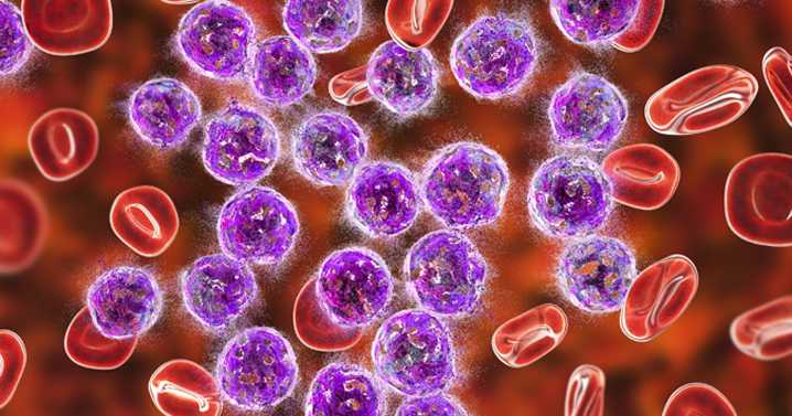 Liso-cel continues to outperform standard of care in leukemia