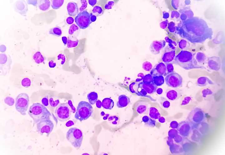 Study Links High-Fiber Diet to Delayed Myeloma Progression