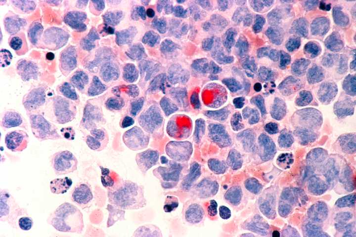 Kura Oncology Drug’s Data at ASCO Support FDA Filing Now Under Priority Review for Leukemia