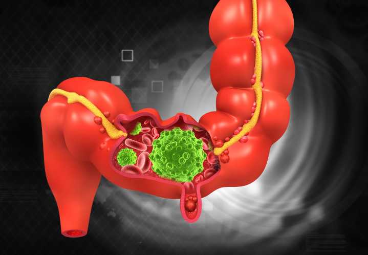 Colorectal Cancer Stages Tied to Microbiome, May Improve Non