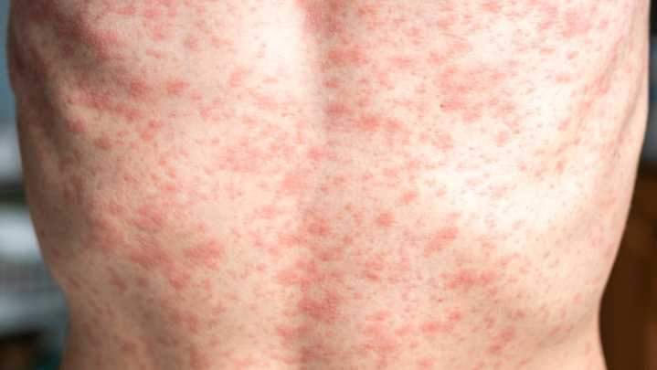 Michiganders exposed others to measles in Oakland, Kent counties