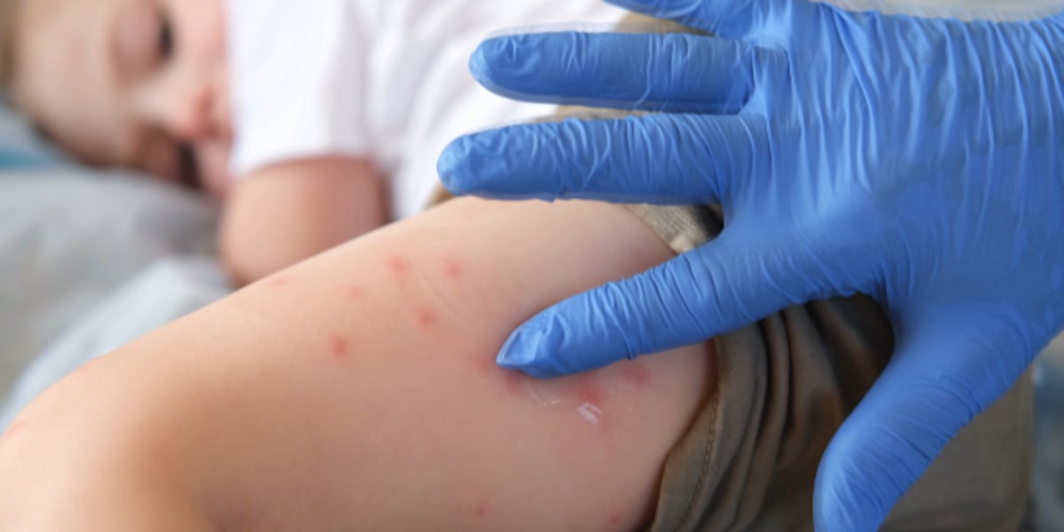 First case of measles confirmed in Bell County, Texas