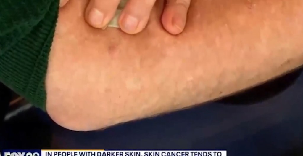 TV Host Learns That He Has Skin Cancer Live On The Air