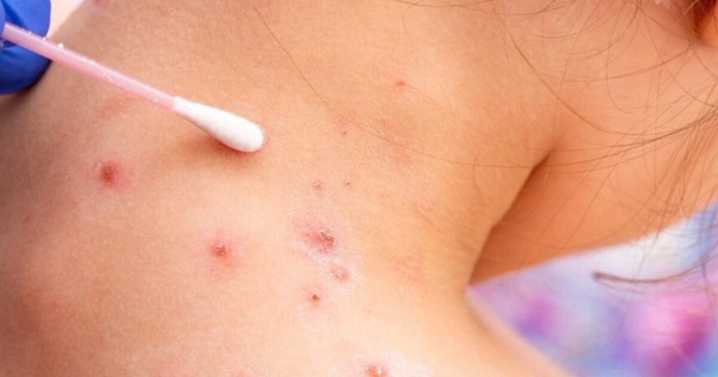 Hill County reports another case of measles