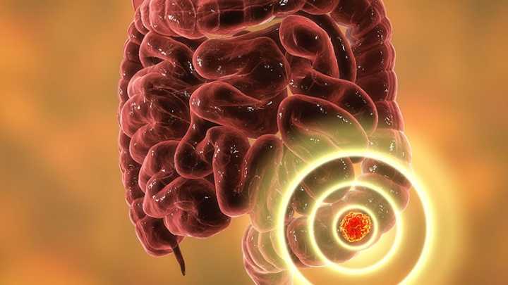 Targeted Therapy Wins Big for BRAF-Mutated Metastatic CRC
