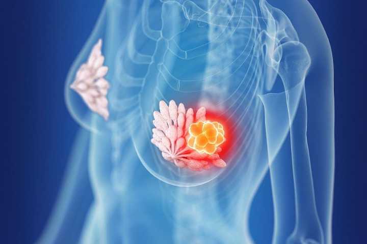 ASCO: Vepdegestrant Ups Survival in ER+, HER2− Advanced Breast Cancer With ESR1 Mutations