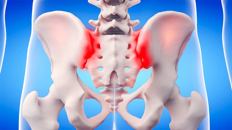 Sacroiliac MRI Lesions Set Apart axSpA and Other Back Pain