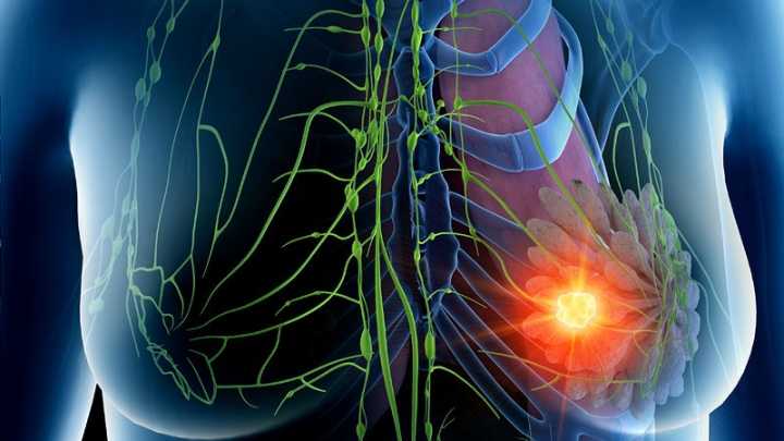 Catching Resistance Early: Can New Breast Cancer Drug Help?