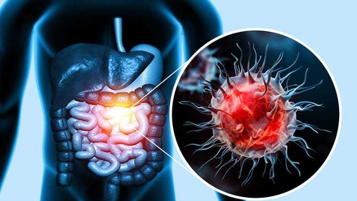 Atezolizumab + Chemo Improves Colon Cancer Survival