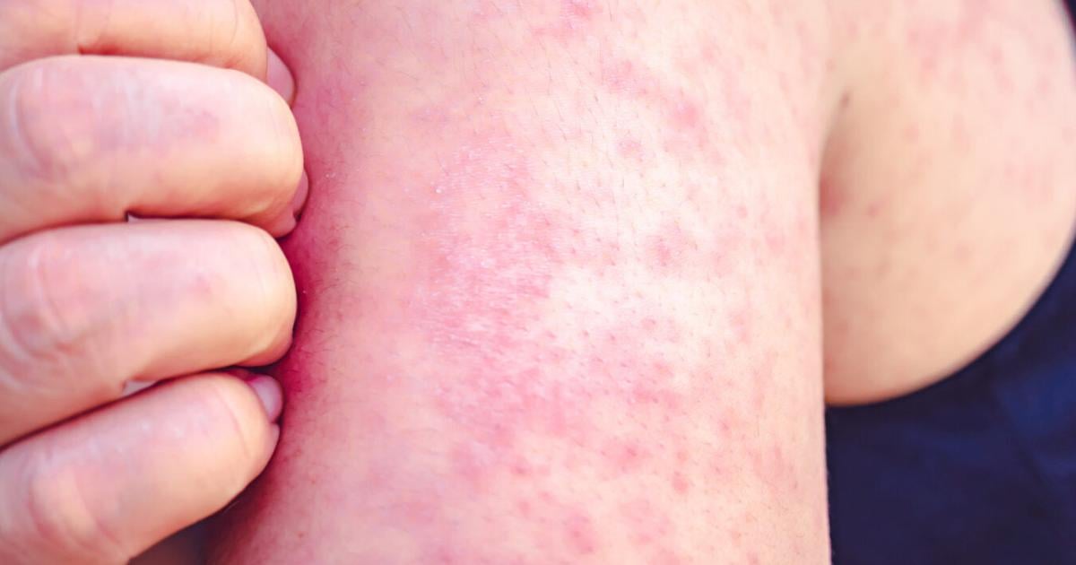 Gallatin Health Dept. announces 11th measles case — and exposures at popular Bozeman spots