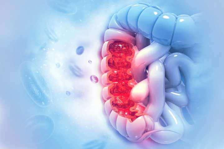 Blood-Based Screening Shows Mixed Results for Colorectal Cancer