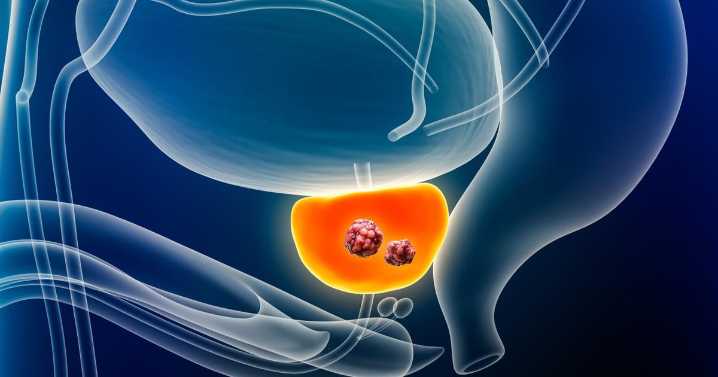 El 75% de pacientes con cáncer de próstata se cura gracias al diagnóstico precoz