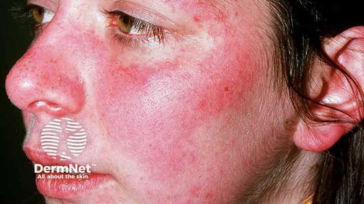 Enpatoran Shows Promise in Treating Lupus Rash