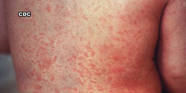 VDH confirms state’s third measles case in 2025
