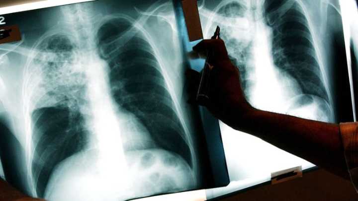 Tuberculosis Fast Facts