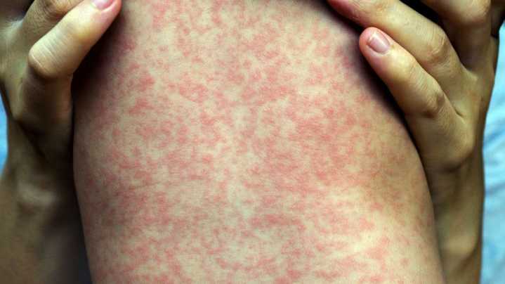 Utah health officials monitoring potential measles exposure in southwestern Utah