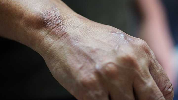 Systemic Psoriasis Therapy Linked to Less Dementia