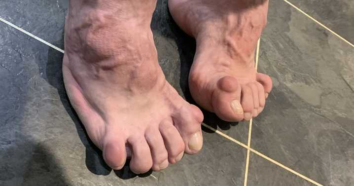 Kids called me 'Slug Feet' and I was heading for amputation until one thing changed